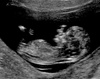 12 week scan of Dot! Our number three on the way! Everything is looking fine, due date of June 22, 2017 and funnily enough, this is 3 years to the day that we had Iris' 12 week scan.